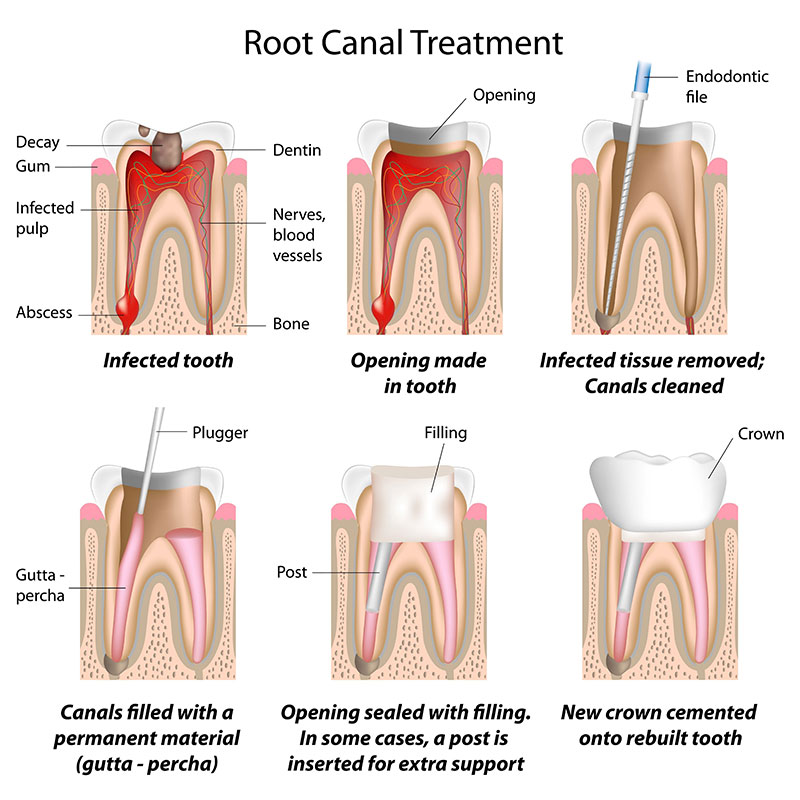 Endodonzia - Studio Intini